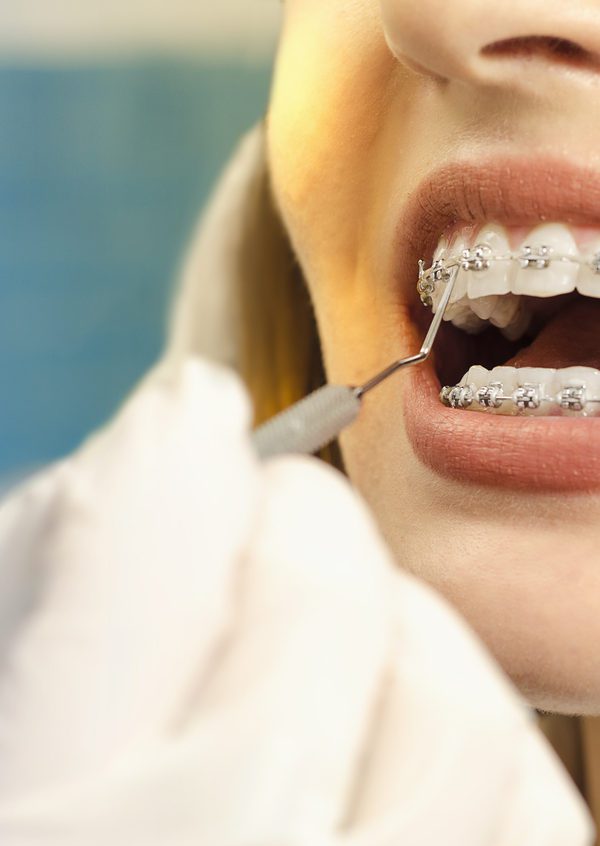 Aparelho ortodôntico: Existe idade certa para usar?